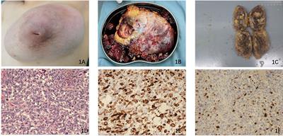 Case Report: A 13-year-old adolescent diagnosed as malignant phyllodes tumor combined with rhabdomyosarcoma differentiation